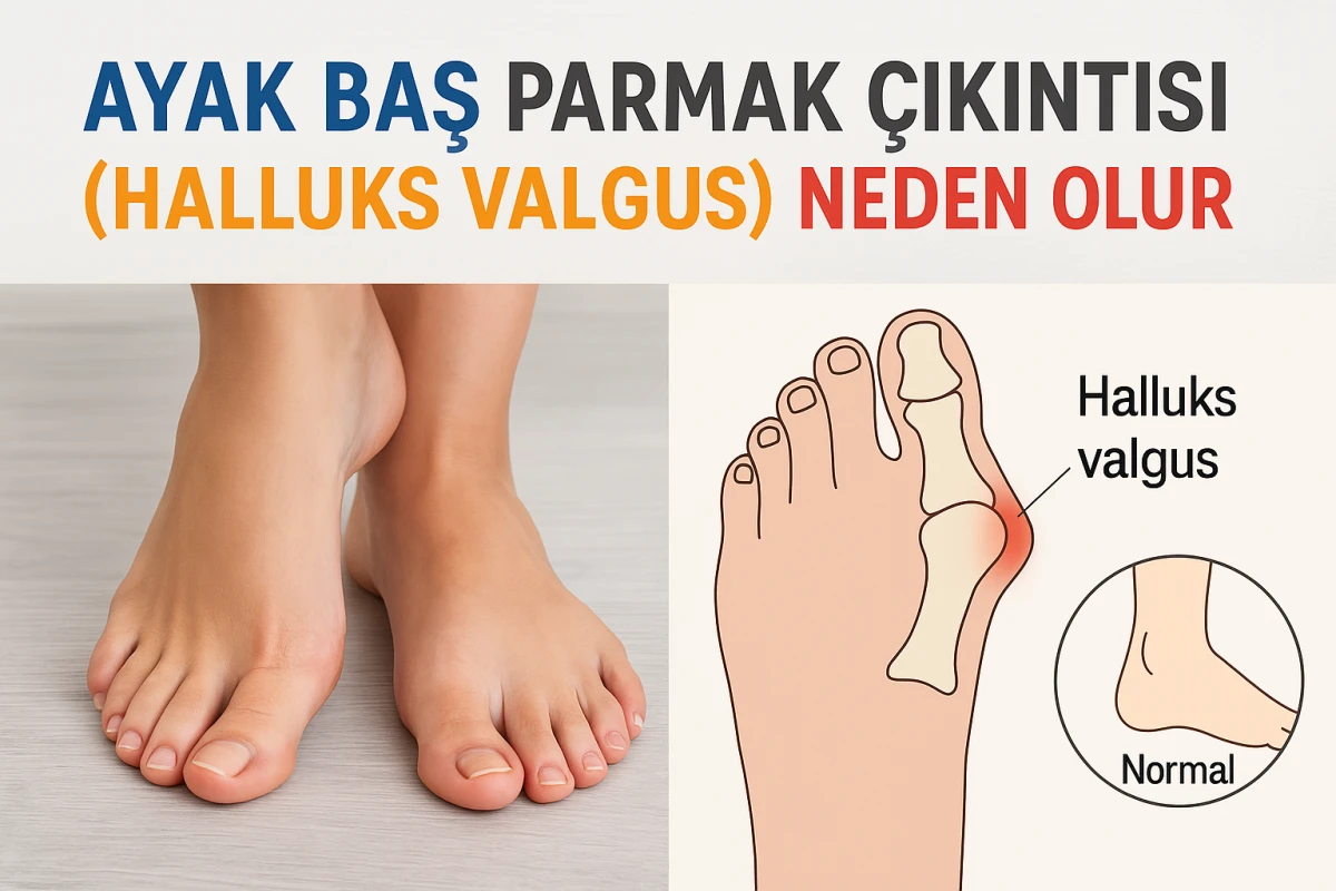 Ayak Baş Parmak Çıkıntısı (Halluks Valgus) Neden Olur?